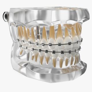 3D model Transparent Dental Typodont With Bracket and Dental Implants