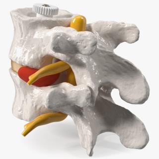 3D Part of Spinal Column with Hernia model