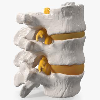 3D Spinal Vertebrae with Hernia model