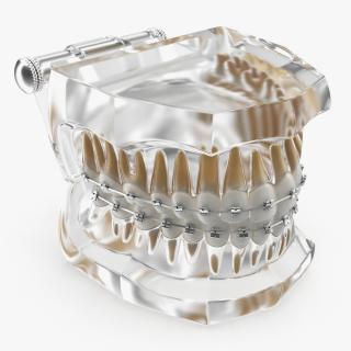 3D Transparent Dental Typodont Teeth Model With Braces