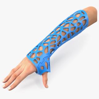 -Printed Orthopedic Cast On Hand 3D