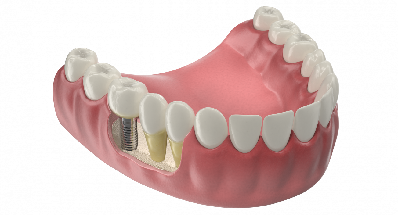 3D model Lower Teeth Medical Model With Dental Implant