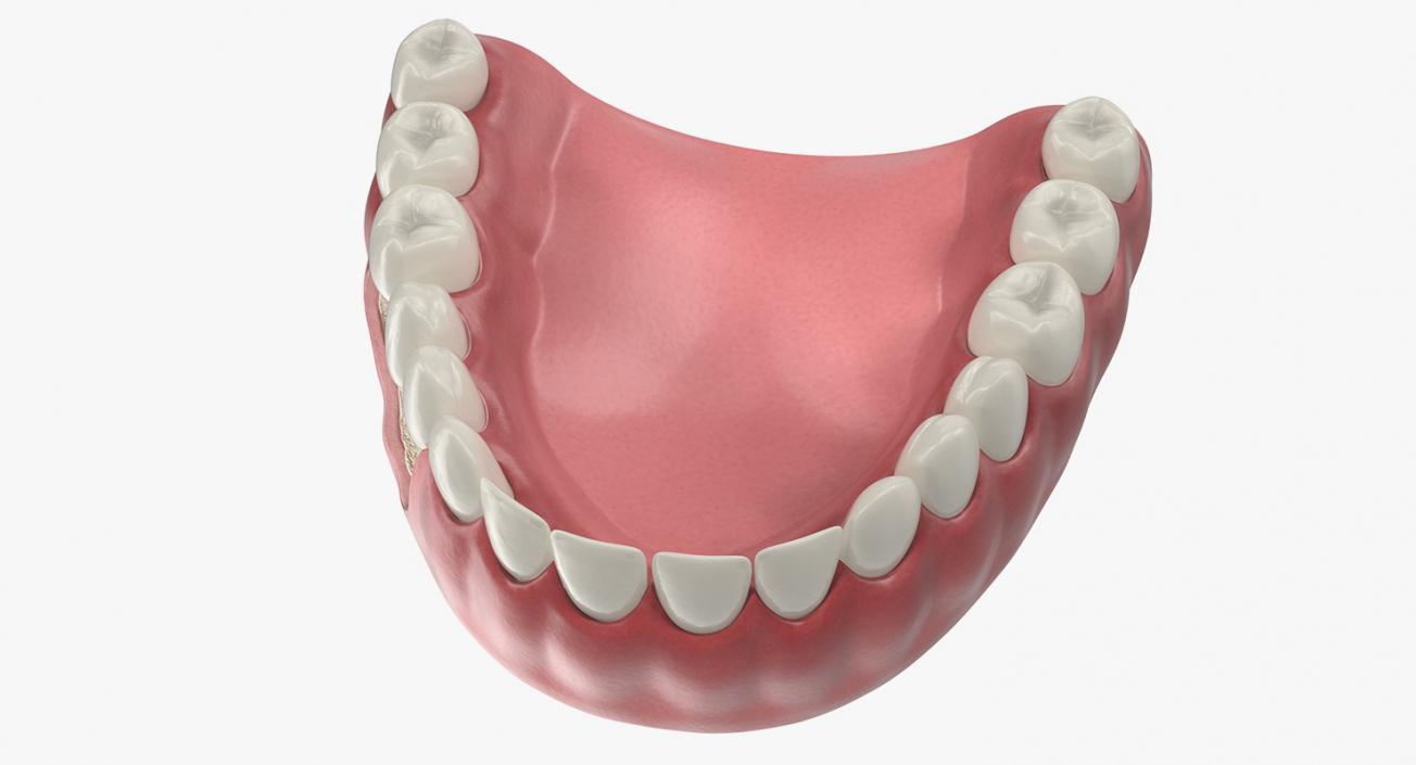 3D model Lower Teeth Medical Model With Dental Implant