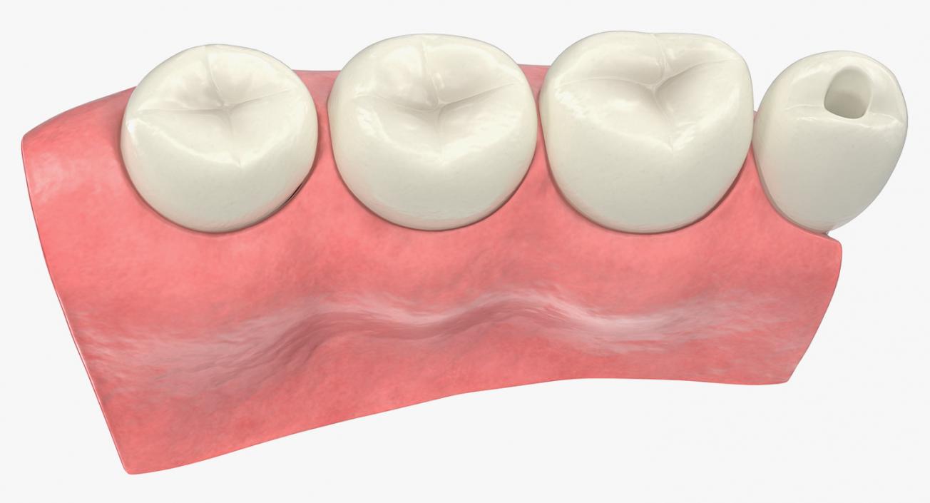 3D Education Tooth Implant model