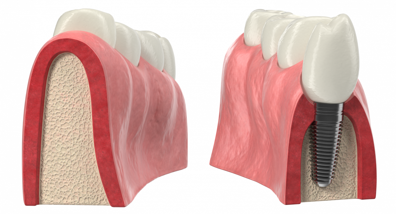 3D Education Tooth Implant model