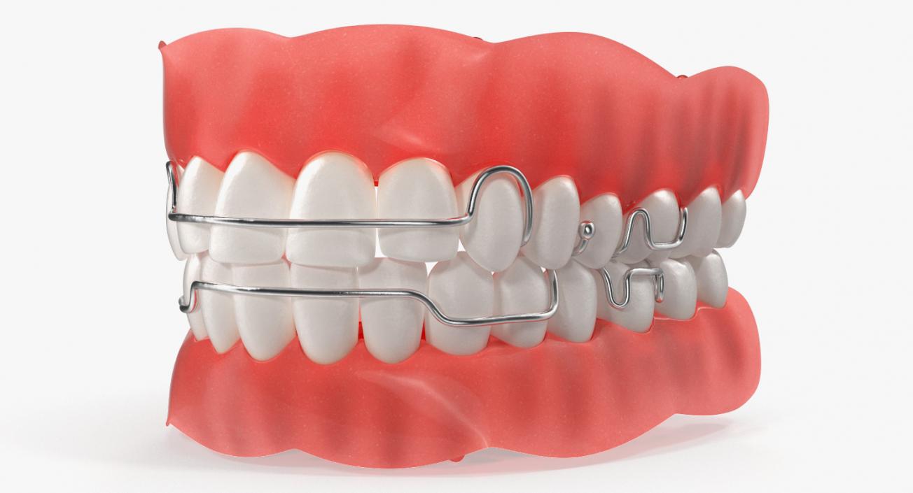 3D model Typodont Tooth Orthodontic Retainer