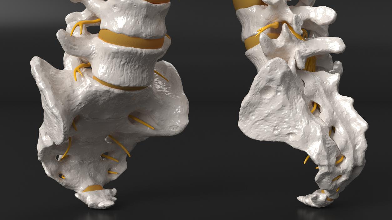 3D model Spinal Column with Hernia