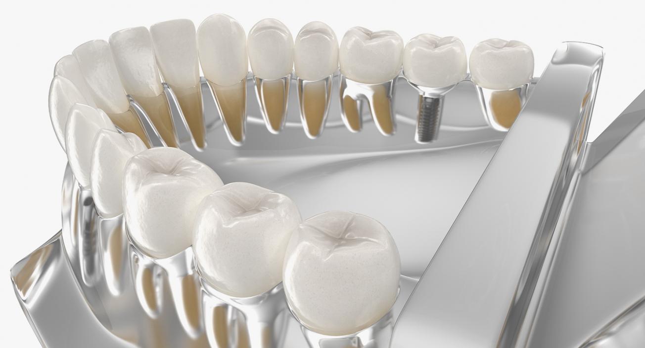 3D Transparent Dental Typodont With Dental Implants model