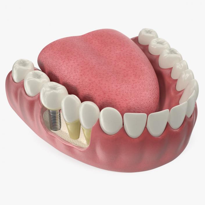 3D Teeth Tongue Medical Model With Dental Implant