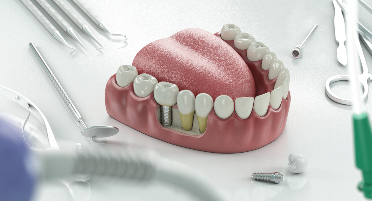 3D Teeth Tongue Medical Model With Dental Implant